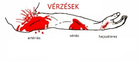 belső visszér vérzés)